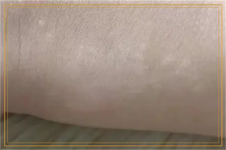 白癜风初期照伍德灯显示什么颜色