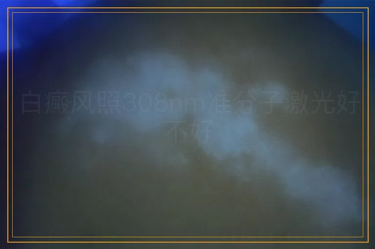 白癜风照308nm准分子激光好不好