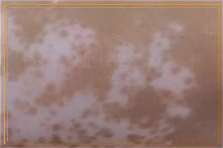 一条脉络上长白癜风是为什么
