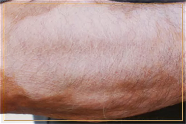 极速308激光照白癜风功效怎么样