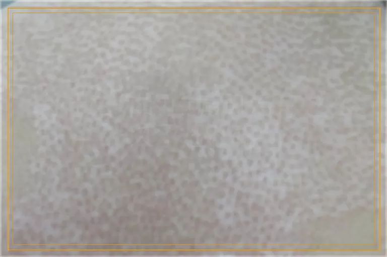 为什么你的白癜风治疗这么久了还没好