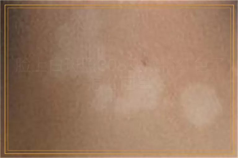 脸上白斑照308变成粉红色了怎么回事