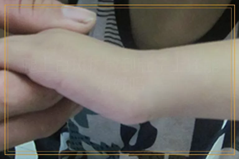 腿上白斑扩散到肚子上还能治好吗