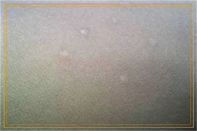 白癜风的诱发病因能检测出来吗