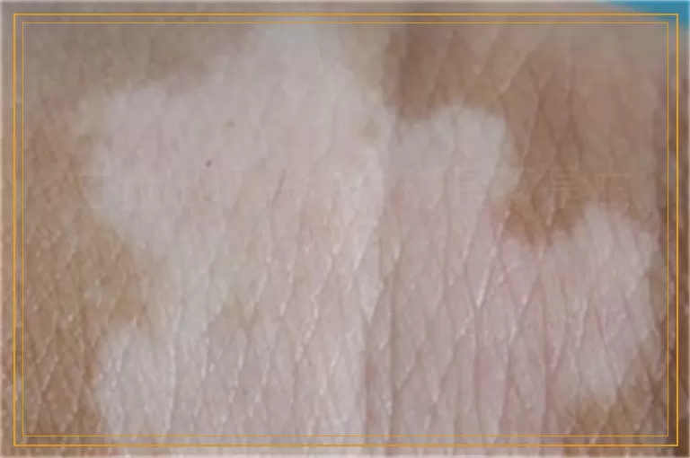 左脸出现一块白斑是不是白癜风