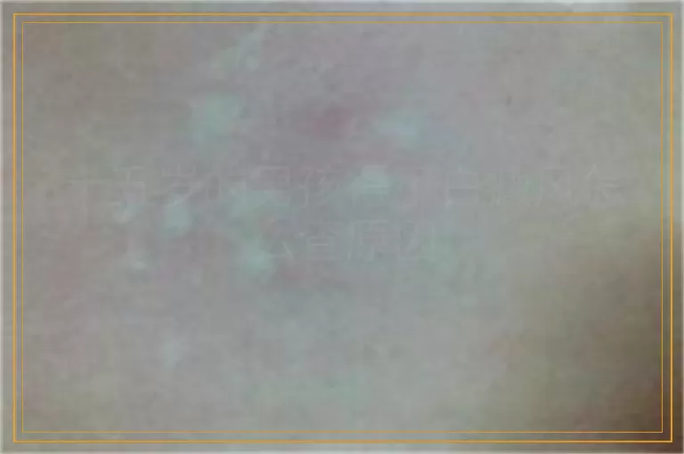 十五岁的男孩得了白癜风怎么查原因