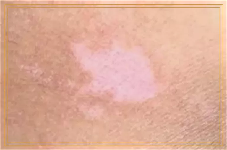 治疗腿部白癜风怎样控制扩散