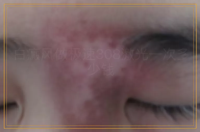 白癜风做极速308激光一次多少钱