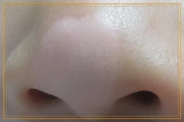 伍德灯下皮肤亮蓝白色是不是白癜风