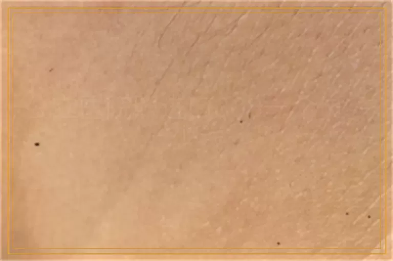 公立医院照进口308一个斑多少钱