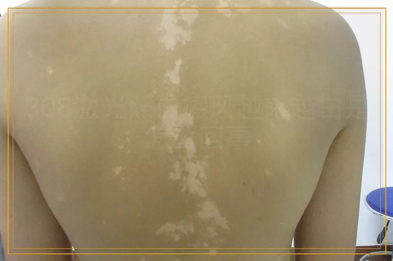 308激光照白癜风越来越白是怎么回事