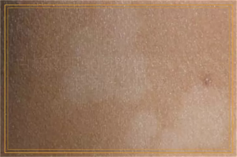 白癜风照308激光后再照阳光很痒怎么回事