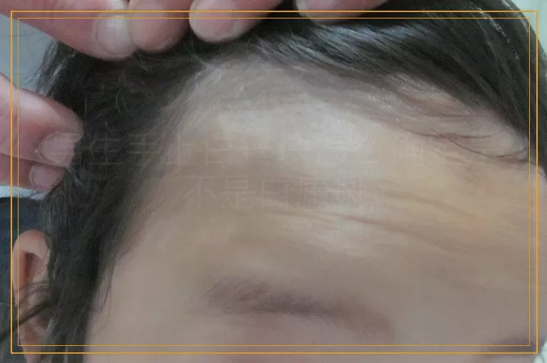 男生手上白一块怎么确定是不是白癜风