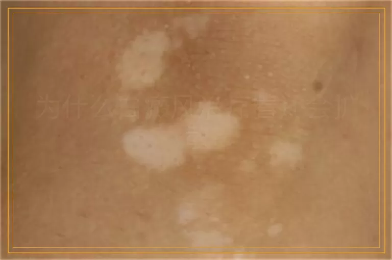 为什么白癜风治疗着还会扩散