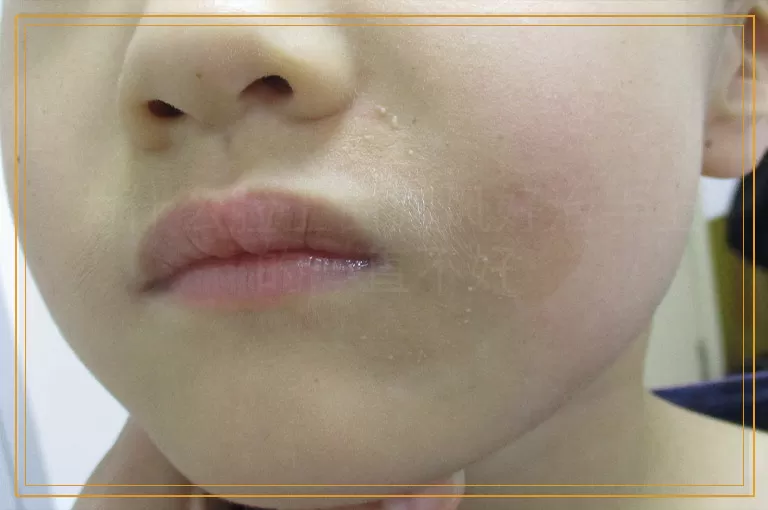 为什么脸上白癜风好治手上的一直不好