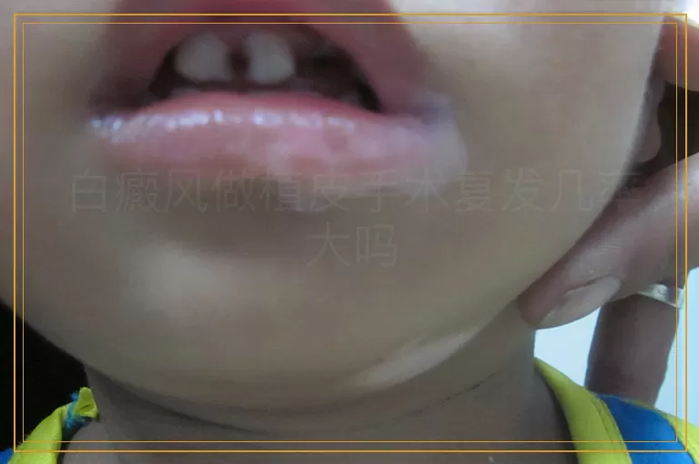 白癜风做植皮手术复发几率大吗