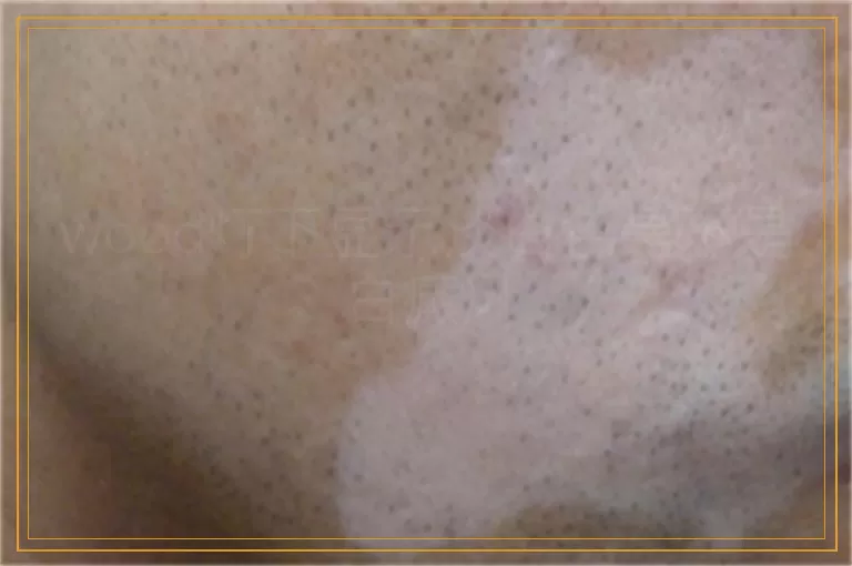 wood灯下显示淡白色是不是白癜风