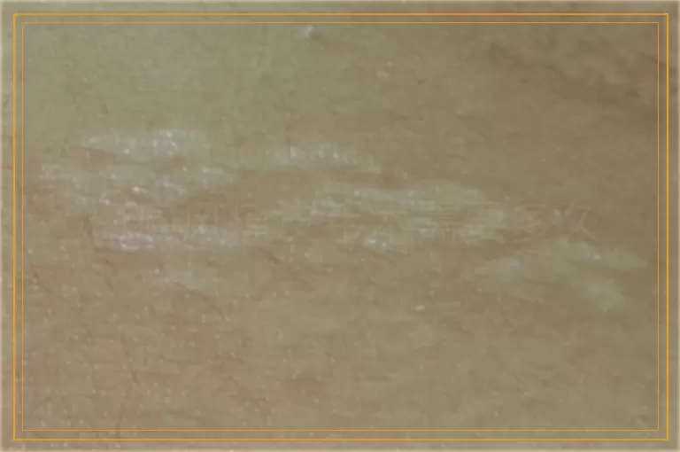 白癜风植皮手术需要多久