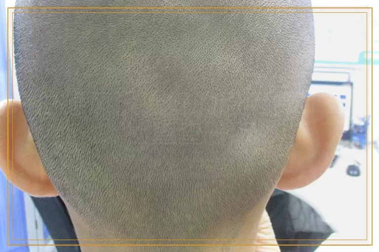 白癜风没治好的原因做什么检查查一下