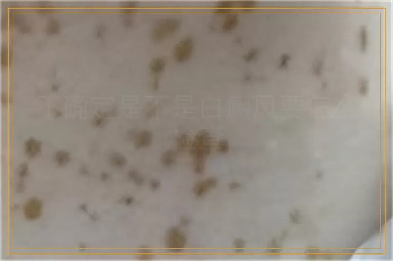 不确定是不是白癜风要怎么检查