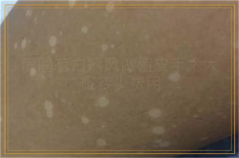 肩膀有白癜风做植皮手术大概多少费用