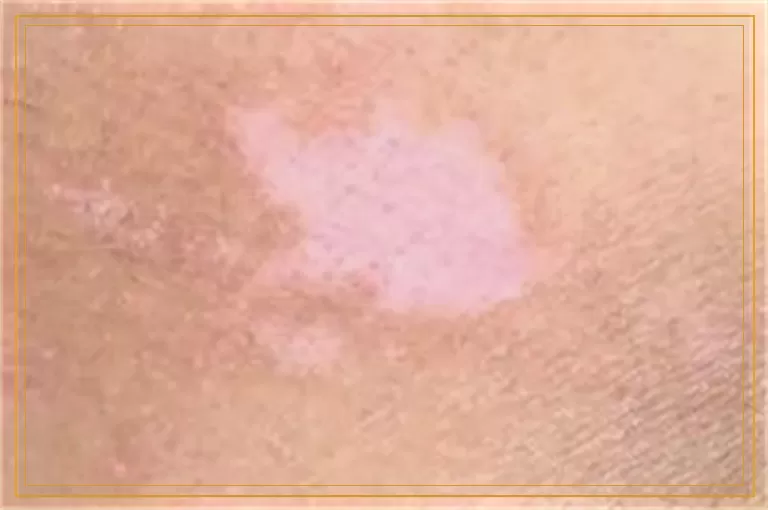 检查白癜风用皮肤ct准确是真的吗