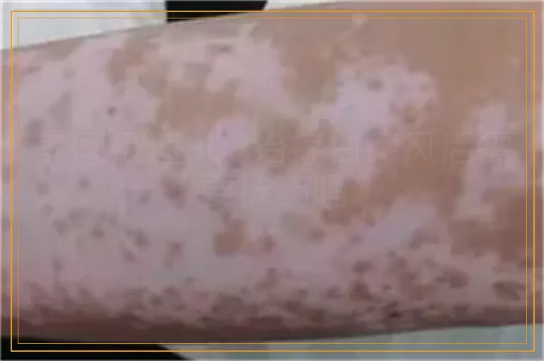 美国极速308治疗白癜风后需要抹药吗