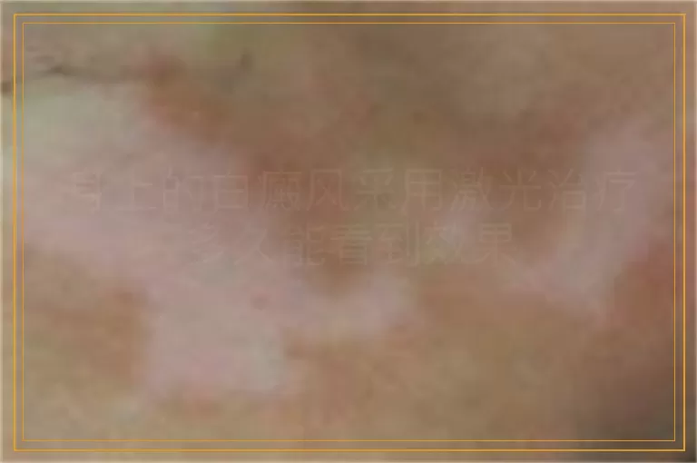 身上的白癜风采用激光治疗多久能看到效果