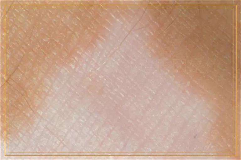 长白癜风怎么知道病因是什么