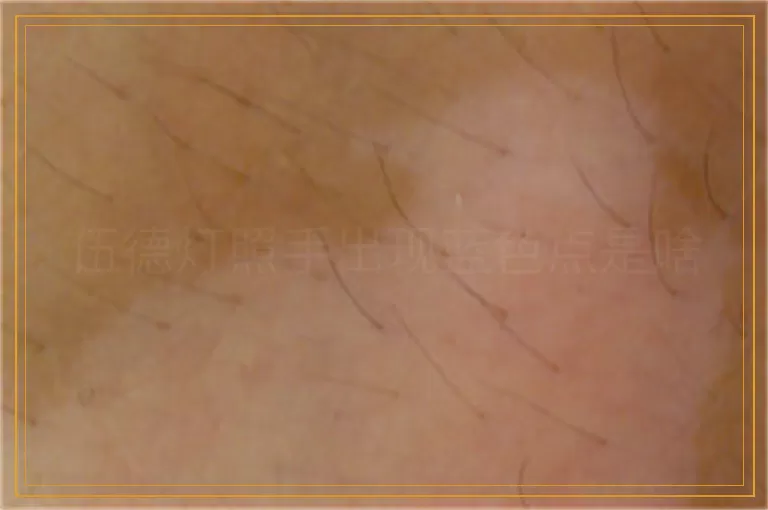 伍德灯照手出现蓝色点是啥