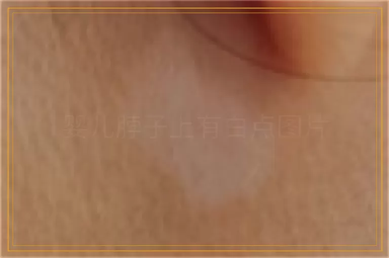 婴儿脖子上有白点图片