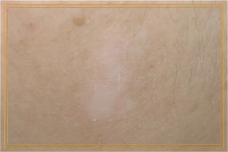 宝宝腿上有一块白色摸着光滑是什么