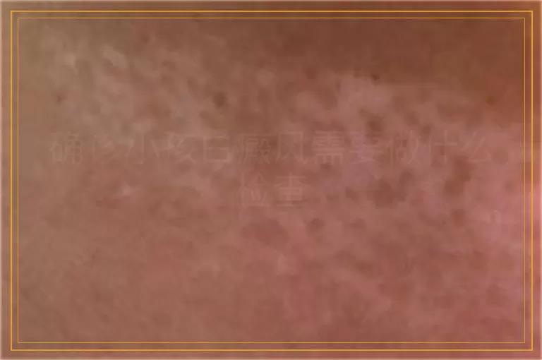 确诊小孩白癜风需要做什么检查