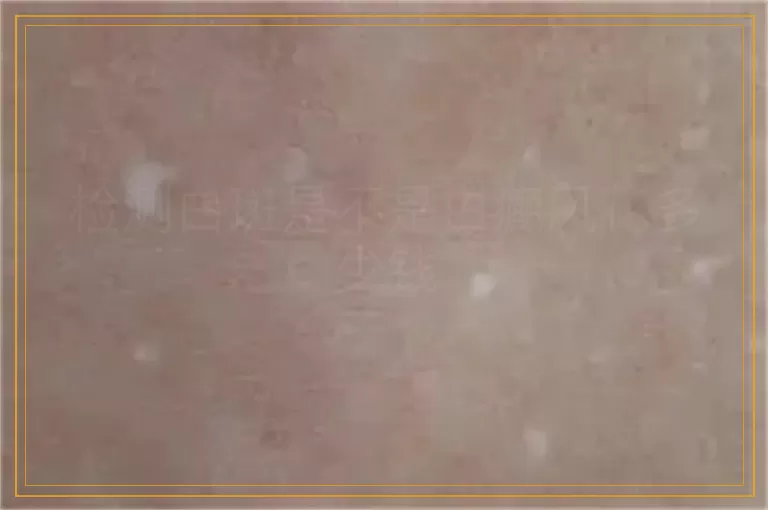 检测白斑是不是白癜风花多少钱