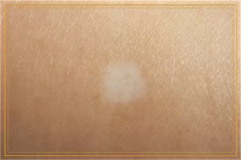 白癜风照308准分子过度会怎么样