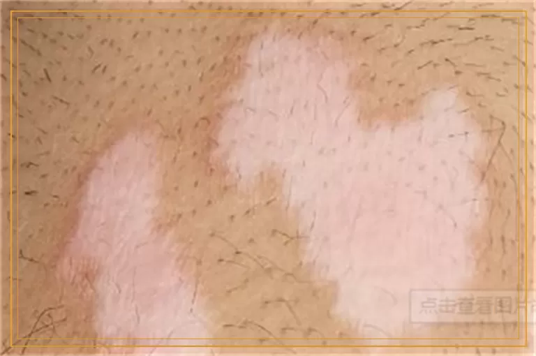 皮肤上出现好多白点是怎么回事