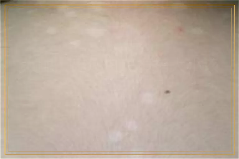 大腿上出现白斑拇指大小该怎么办