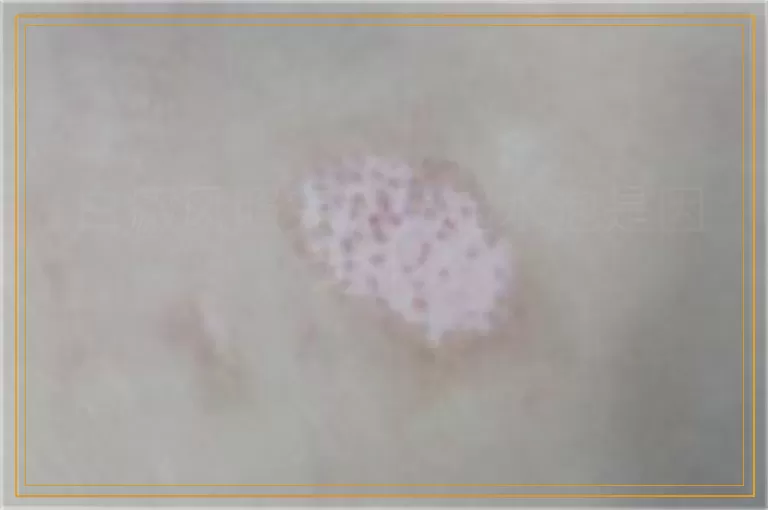 白癜风照完激光起水泡是因为什么