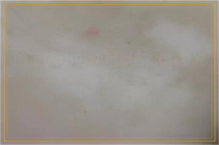 脸上的小白块可以照308激光吗