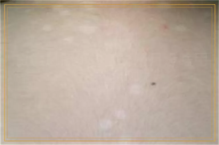 白癜风照308激光两月没啥用还要坚持吗