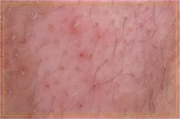 白癜风黑色素细胞种植手术需要多长时间