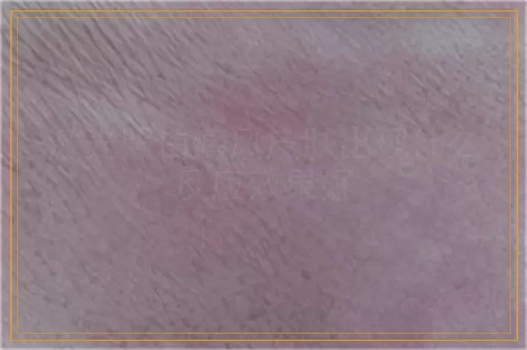 激光照白癜风皮肤出现什么反应效果好