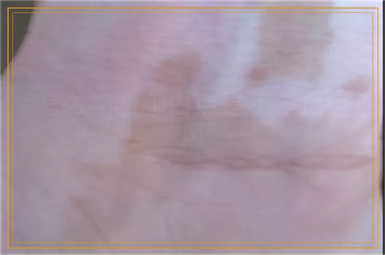 怎么判断小白点是不是白癜风