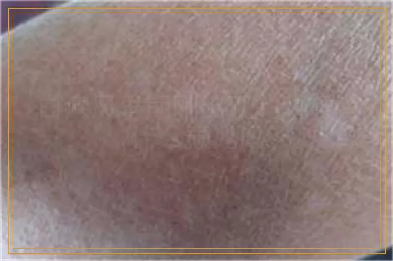 白癜风早期刚出现的时候有什么预兆吗