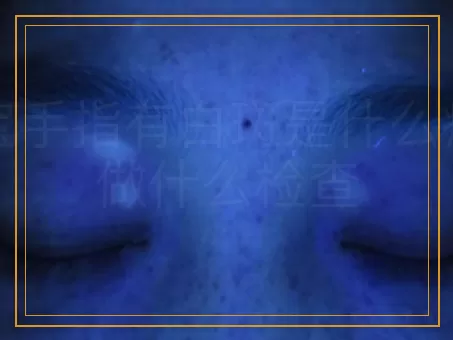 宝宝手指有白斑是什么病该做什么检查