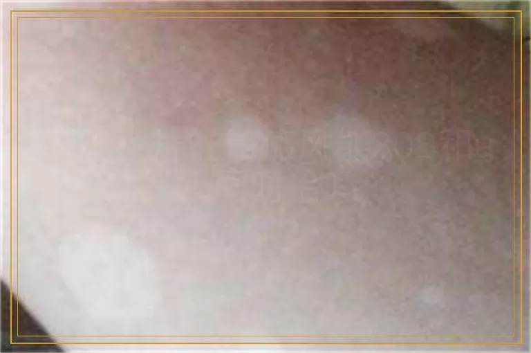 下巴大片的白癜风能308和uvb同时治吗