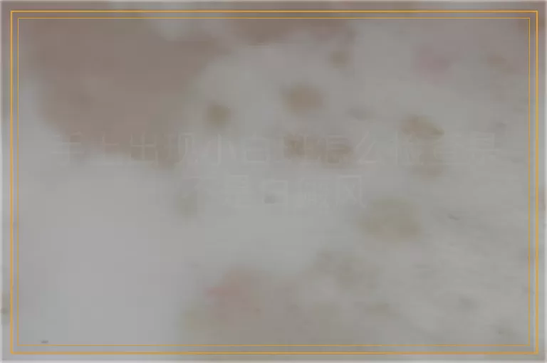手上出现小白斑怎么检查是不是白癜风