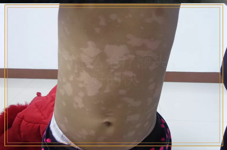 308治疗怎么治疗额头白癜风好的快