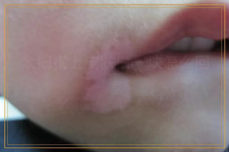 大拇指上皮肤白一块怎么回事