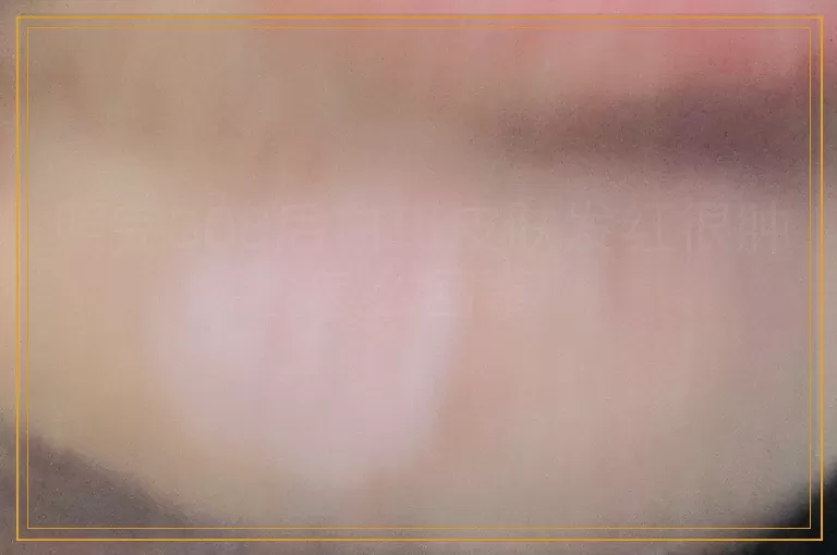 照完308后白斑皮肤发红很肿怎么回事